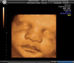 Our baby boy nicolai in 4d ultrasonic. 3d 4d Ultraschall Pranatalzentrum Hamburg Und Humangenetik Im Gynaekologicum