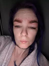 Woman left 'looking like Quasimodo' after deathly reaction to eyebrow tint 