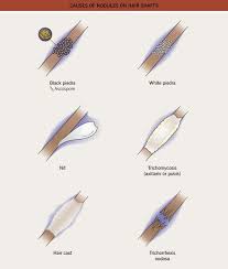 Was first described by biegel in 1865. Fungal Diseases Clinical Gate