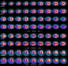 Image result for Nuclear Ventriculogram