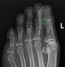 Image result for Toe Fracture