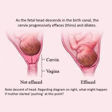 Image result for Friable Cervix
