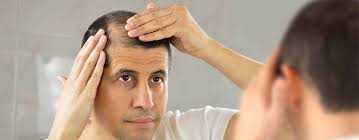 Hair shedding and hair loss (baldness patterns) are often used as interchangeable terms, but there is a significant difference between the two? Seasonal Hair Loss When Should We Worry About It