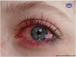 Why Are My Eyes Dry And Itchy And 19 Home Remedies For Red Itchy Eyes Crying Eyes Aesthetic Eyes Crying Aesthetic