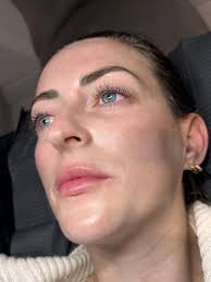 Time reduction in applying second set in 45 minutes