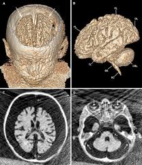 Haz clic en la imagen para ampliarla. Multidetector Ct Investigation Of The Mummy Of Rosalia Lombardo 1918 1920 Sciencedirect
