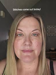 How to Remove Stitches from Face