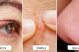 A common way to relieve discomfort from a cyst on the eyelid is to apply warm compresses. Eyelid Bumps 101 How To Identify Styes Milia Pimples Allure