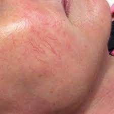 How to get rid of blood blisters. Red Vein Reduction Treatments Clear Skincare Clinics