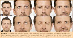 Facial Nerve Schwannomas: Review of 80 Cases Over 25 Years at Mayo Clinic. 