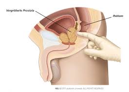 Vom enddarm her tastet die ärztin oder der arzt die prostata ab. Prostatakrebs Pi De