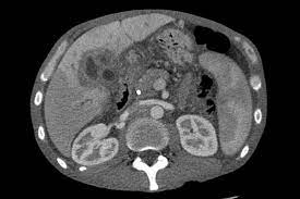 For most children with liver cancer, there is no known cause. Liver Cancer Wikipedia