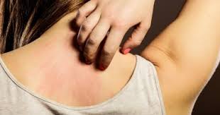 7 طرق طبيعية لعلاج الطفح الجلدى منها البيكربوناتو اليوم السابع