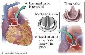 Mechanical And Tissue Valves And Where They Fit In The Heart Aortic Valve Replacement Mitral Valve Heart Valves