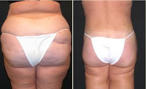 Patient Had Two Large Volume Liposuction Procedures First Stage Was Waist And Upper Buttocks And Second S Liposuction Procedure Liposuction Thigh Liposuction