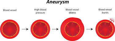 Aortic Aneurysm Tampa General Hospital