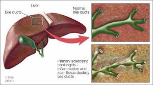 Maybe you would like to learn more about one of these? Tcri What Is Psc Primary Sclerosing Cholangitis Psc Is A Rare And Chronic Disease In Which The Ducts That Transport Bile From The Liver Develop Inflammation And Scar Over Time If