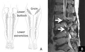 Learn some theories about its origin as well as practical ways to help your students prevent or treat si problems. Groin Pain Associated With Sacroiliac Joint Dysfunction And Lumbar Disorders Sciencedirect