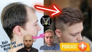 Hair Transplant Network Podcast #5 Dr. Mwamba- Live Q&A, Hairline Repairs,  and Topical Finasteride