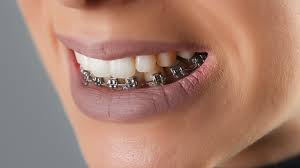 If your tooth is severe case. Can Your Teeth Shift Back After Braces Align Ortho