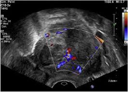 However, fibroids can cause a number of symptoms depending on their size, location within the uterus, and how close they are to. A Rare Case Of Ovarian Adenomyoma Mimicking Primary Invasive Ovarian Cancer With A Contralateral Serous Borderline Ovarian Tumor A Case Report And Review Of The Literature Sciencedirect
