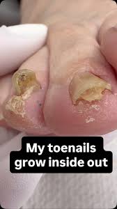Image result for Onychogryphosis feet