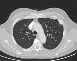 Some of these opacities are clearly bordering the chest wall (red arrows). Asbestos And The Lung In The 21st Century An Update Prazakova 2014 The Clinical Respiratory Journal Wiley Online Library