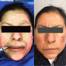 Dr. Fernando Guerrero. Cirugía Plástica