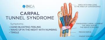 Image result for karp ln  tunel ort za