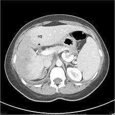 Budd Chiari Syndrome Radiology Case Radiopaedia Org