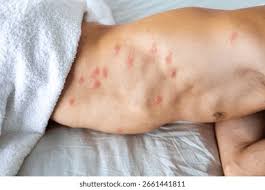 Image result for mosquito bite