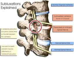 This Chiropractic Chart Explains Nerve Subluxation When A