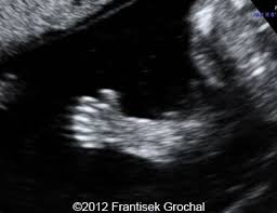 Wk 7 L 1polydactyly Obstetric Ultrasound Medical Ultrasound Diagnostic Medical Sonography