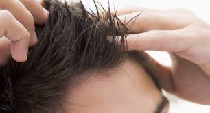 Ogni giorno cadono dai cinquanta ai cento capelli, ma in autunno, tra ottobre e dicembre, la perdita fisiologica può essere maggiore. Perdita Dei Capelli Usare Il Gel Fa Cadere I Capelli Trapianto Capelli Hsd