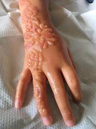 Looking for henna tattoo ideas? Parents Tell Of Agony After Daughter 7 Was Left With Huge Disfiguring Scars From Holiday Henna Tattoo