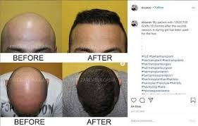Not all of these factors are present in each individual but the existence of any of these conditions can contribute to. Dr Zarev Archives Hair Loss Cure 2020