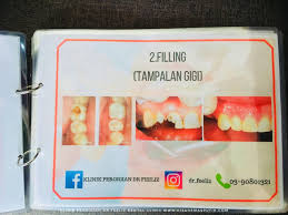 Apa cara putihkan gigi semulajadi mengikut petua orang lama? Buat Rawatan Whitening Teeth Putihkan Gigi Di Klinik Pergigian Dr Feeliz Dental Clinic Emas Putih