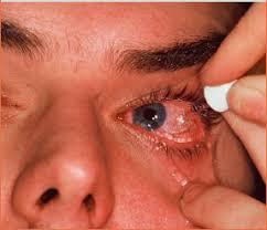 Image result for Eye Irrigation