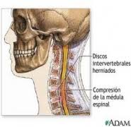 ¿qué es el dolor de espalda? Estenosis Cervical Vithas Madrid La Milagrosaestenosis Cervical Vithas Madrid La Milagrosa