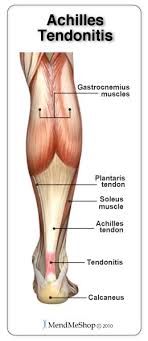 Diagram showing chronic achilles tendon tear. Achilles Tendonitis Information And Effective Treatments To Avoid Reinjury Achilles Tendonitis Tendinitis Achilles