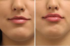 To help alleviate swelling, we recommend an antihistamine during the day, such as zyrtec or claritin, and benadryl at night. Restylane Dallas Facial Fillers For The Cheeks And Lips