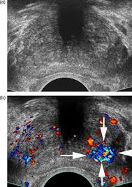 The gleason score is used to determine the grade group. Contrast Enhanced Ultrasound For Diagnosis Of Prostate Cancer And Kidney Lesions European Journal Of Radiology