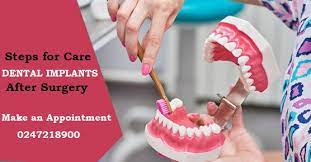 How To Care Dental Implants After Surgey Dental Implants Dental Implant Surgery Dental