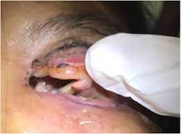 In mammals (including humans), dipterous larvae can feed on the host's living or dead tissue, liquid body substance, or ingested food and cause a broad range of infestations depending on the body location and the relationship of the larvae with the host. Massive Orbital Myiasis Arising From Nasal Myiasis In An Indonesian Patient With Diabetes Sciencedirect