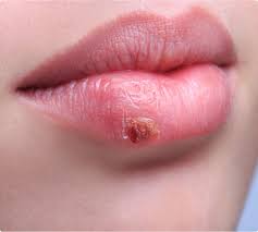 Other nonoral herpes simplex virus type 1 infections include herpetic keratitis, herpetic whitlow, herpes gladiatorum, and herpetic sycosis of the beard area. When Can Acyclovir Be Prescribed When Treating The Lips And Oral Commissures Journal Of Aesthetic Nursing