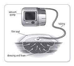 Check spelling or type a new query. Negative Pressure Wound Therapy Wound Care