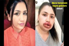 Bağımsız kadının da bazen bir rehbere ihtiyacı olur! Adana Da 22 Yasindaki Merve Keles In Slikon Faciasi Dudaklari Alinabilir Saglik Haberleri