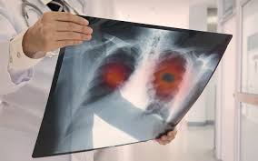 The disease can get worse over time. Asbestosis And Mesothelioma Asbestos Cancer In Veterans