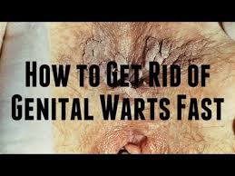 Your doctor might be able to diagnose hpv infection by looking at your warts. Free Online Games Com How To Get Rid Of Genital Warts Fast 365 Health