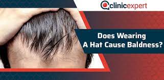 The same problem can happen if you like wearing hats that are simply. Does Wearing A Hat Cause Baldness Clinicexpert